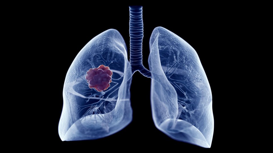 Lung Cancer: Diagnosis, Treatment and Prevention