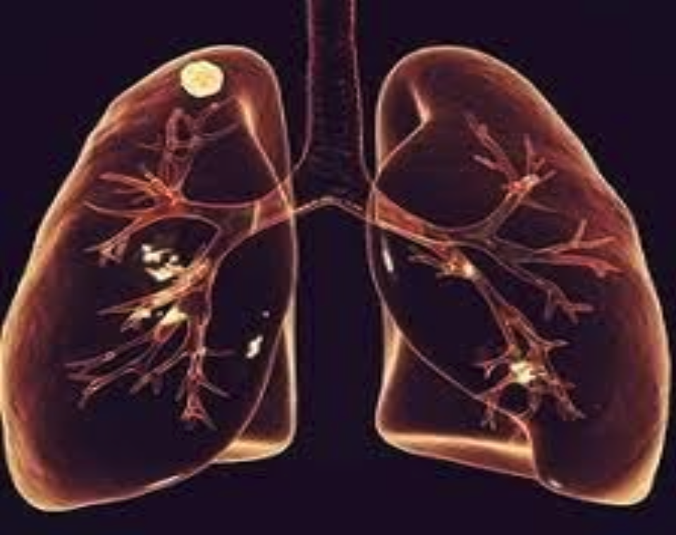 Lung Nodules and Robotic Surgery: Future Treatment Methods