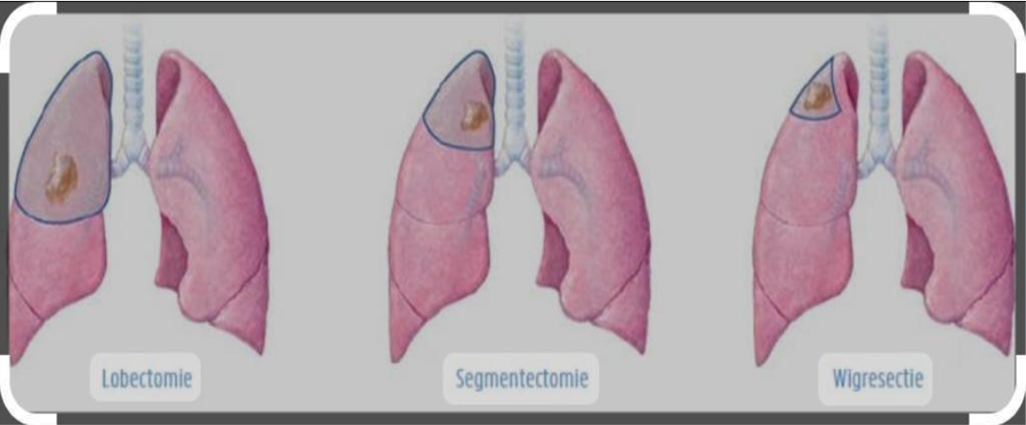 Water Collection in the Lung Membrane: Causes, Treatment and the Role of Robotic Surgery