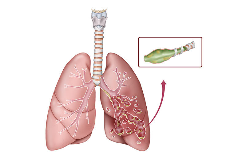 Bronchiectasis: Diagnosis, Causes and Treatment