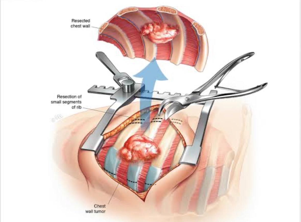 Chest Wall Tumors: Symptoms, Diagnosis and Treatment