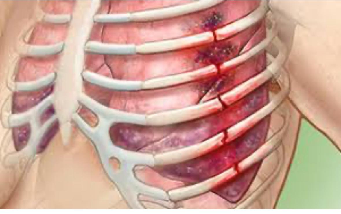 Rib Fractures and the Role of Surgery in Their Treatment