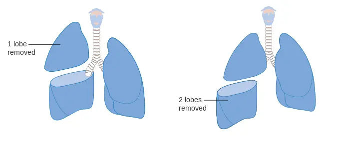 Lobectomy: An Important Step in Lung Surgery