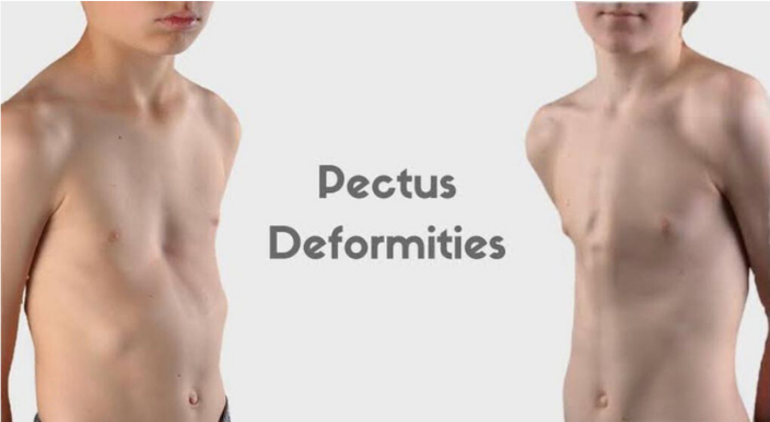 Pectus Excavatum (Funnel Chest) and Pectus Carinatum (Pigeon Chest)