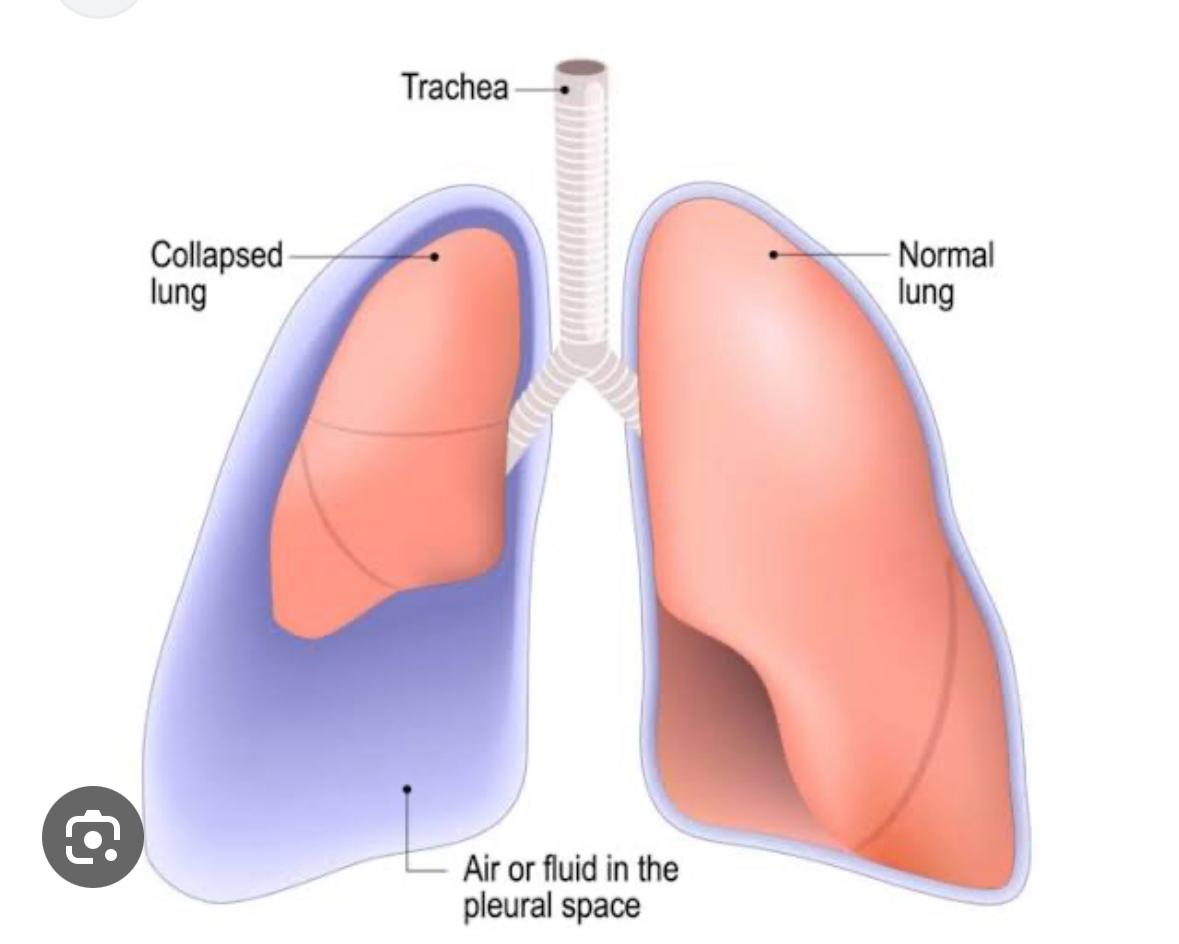 Pneumothorax and Surgical Approaches: How Can You Protect Your Lung Health?