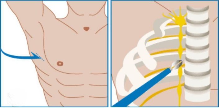 Sympathectomy: A Surgical Intervention That Reshapes Your Heart